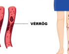 A vérrög 10 korai figyelmeztető jele, amit soha nem szabad figyelmen kívül hagyni