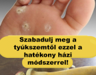 Szabadulj meg a tyúkszemtől ezzel a hatékony házi módszerrel! 👣✨